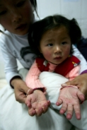 中國當局3月27日才首次對外披露，2008年全國有48.9萬兒童患手足口病，126人死亡。